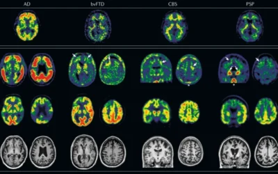 An update on blood-based biomarkers for non-Alzheimer neurodegenerative disorders.