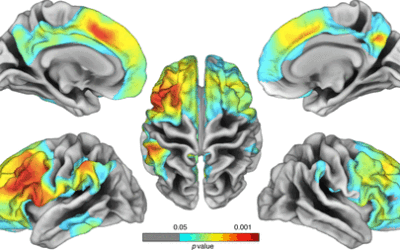 Diagnostic and prognostic value of serum NfL and p-Tau181 in frontotemporal lobar degeneration.