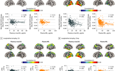 Longitudinal Associations of Blood Phosphorylated Tau181 and Neurofilament Light Chain With Neurodegeneration in Alzheimer Disease.