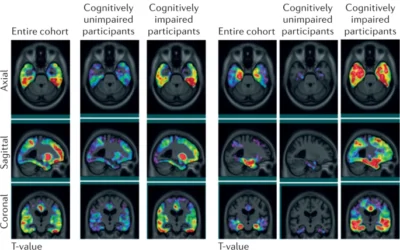 Blood phospho-tau in Alzheimer disease: analysis, interpretation, and clinical utility.