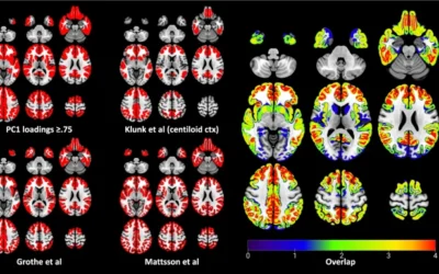 Evaluation of in vivo staging of amyloid deposition in cognitively unimpaired elderly aged 78-94.