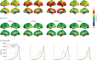 Association of Phosphorylated Tau Biomarkers With Amyloid Positron Emission Tomography vs Tau Positron Emission Tomography.