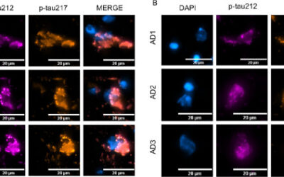 Plasma p-tau212: antemortem diagnostic performance and prediction of autopsy verification of Alzheimer’s disease neuropathology.