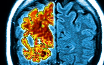 Simple blood test developed to detect Alzheimer’s in potential gamechanger for early detection