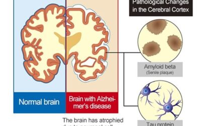 Longitudinal cerebrospinal fluid measurements show glial hypo- and hyperactivation in predementia Alzheimer’s disease.